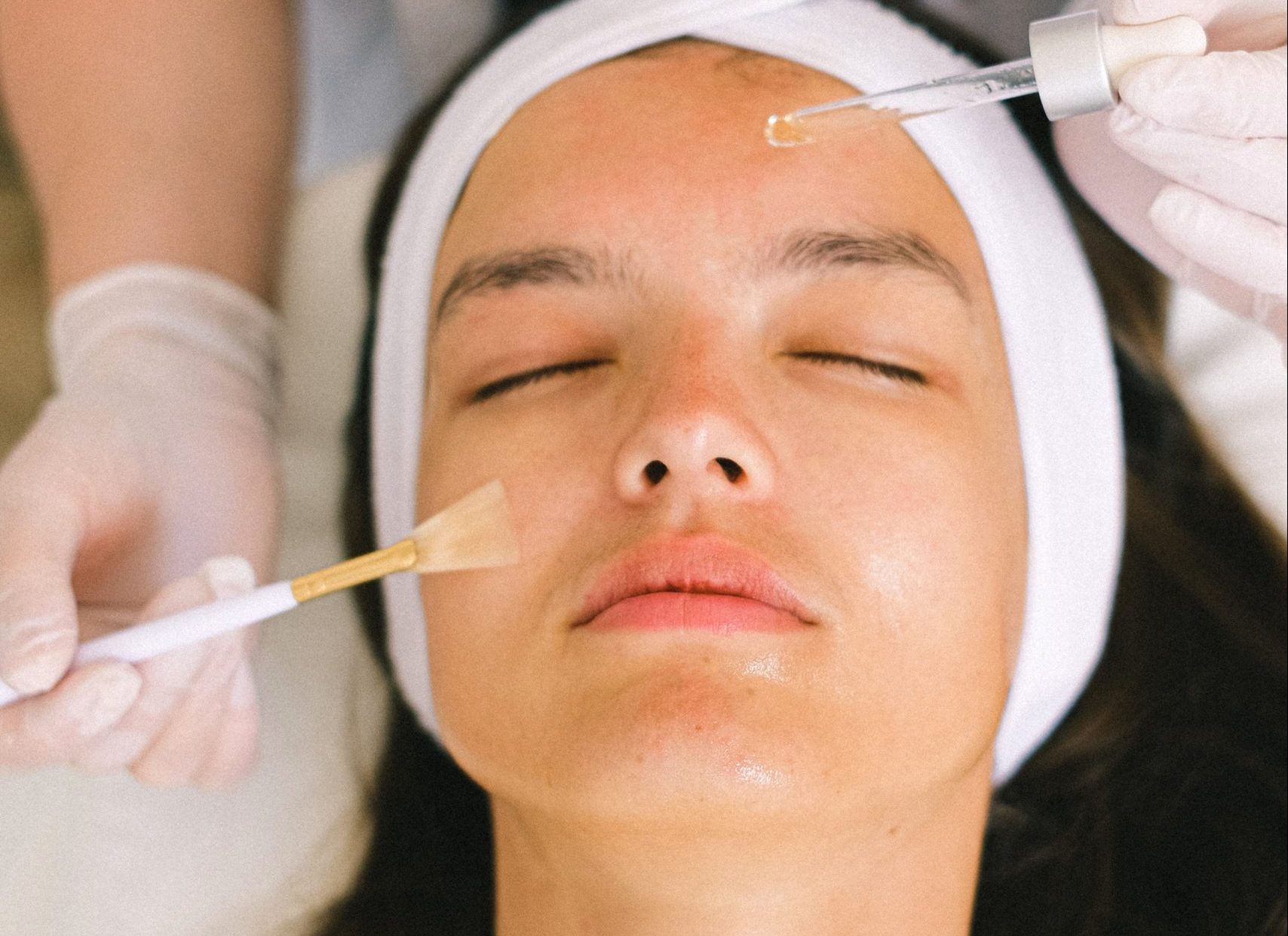 Chemical Peel